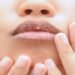 ड्राई लिप्स की करें नारियल तेल से मालिश, मिलेंगे मुलायम और गुलाबी होंठ