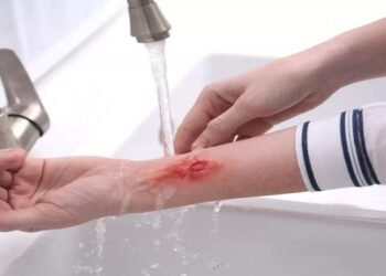 जलने के बाद तुरंत उपचार के लिए आजमाऐ ये 5 घरेलू उपाये