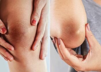 दही में इन चीज़ों को मिलाकर दूर करें कोहनी और घुटनों की ब्लैकनेस, जाने इस्तेमाल का तरीका