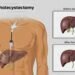 बादशाहनगर हास्पिटल में अब गाल ब्लडर की सर्जरी दूरबीन विधि से होगी