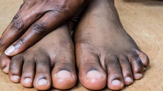 पैरों के कालेपन से अब नहीं होगी शर्मिंदगी…ट्राई करें ये 5 घरेलू नुस्खे पैरों का कालापन 2