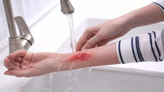 जलने के बाद तुरंत उपचार के लिए आजमाऐ ये 5 घरेलू उपाये