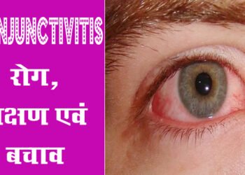Eye Flu