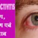 Eye Flu